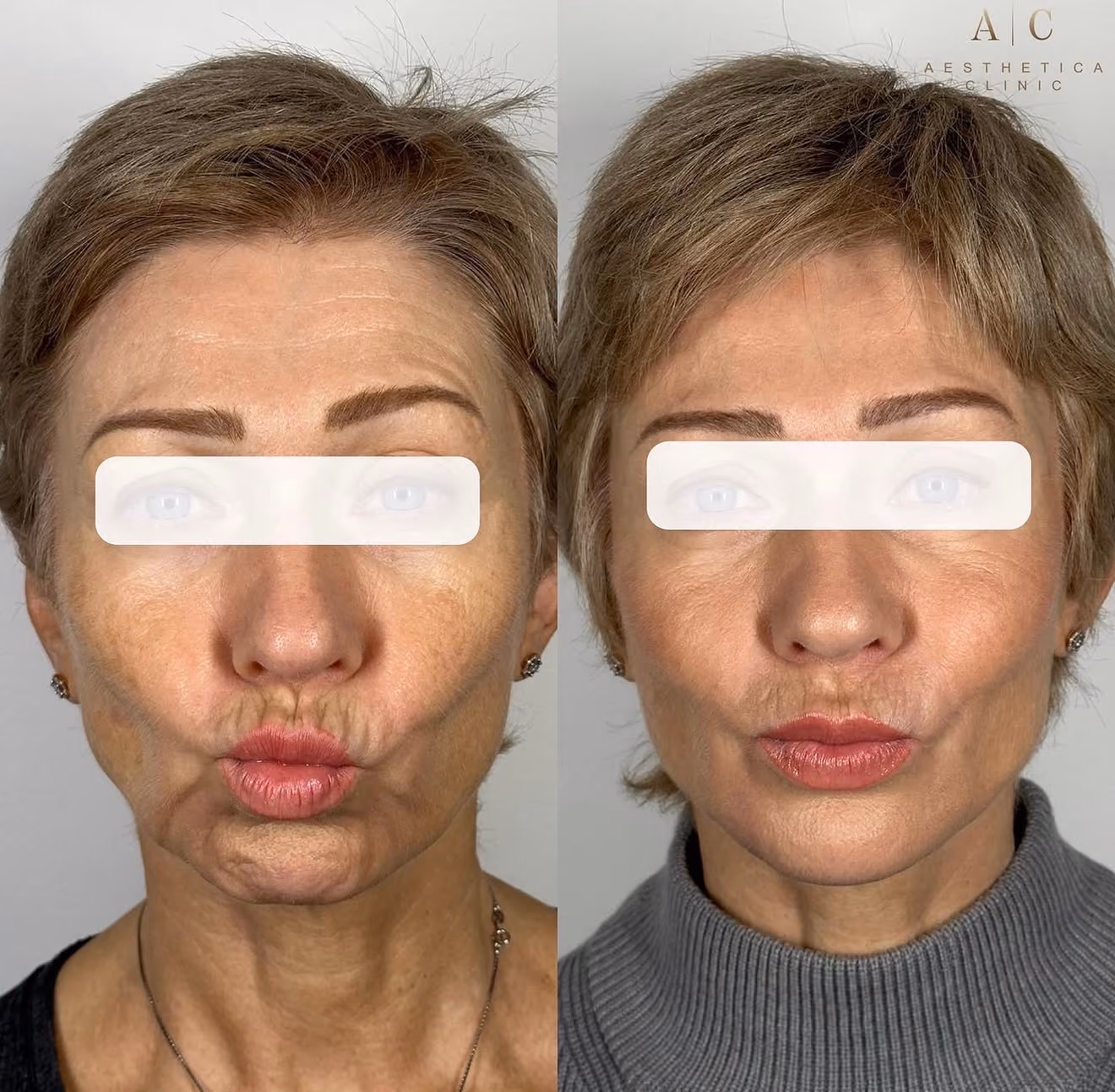 Collagen Stimulation Christchurch | Aesthetica