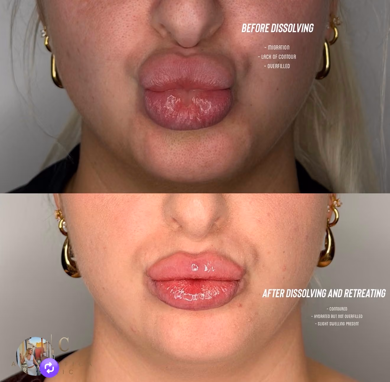 Filler Dissolving Christchurch | Aesthetica