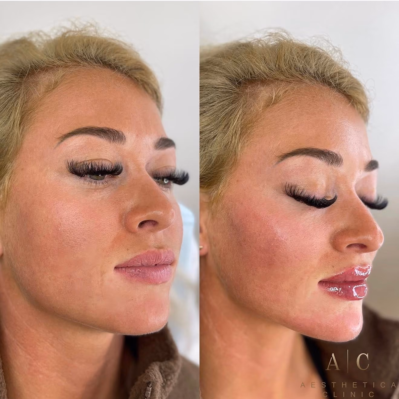 Facial Volume & Contouring Christchurch | Dermal Fillers