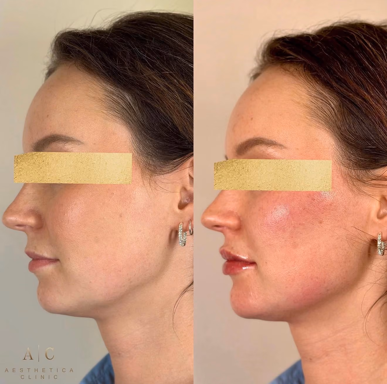 Facial Volume & Contouring Christchurch | Dermal Fillers