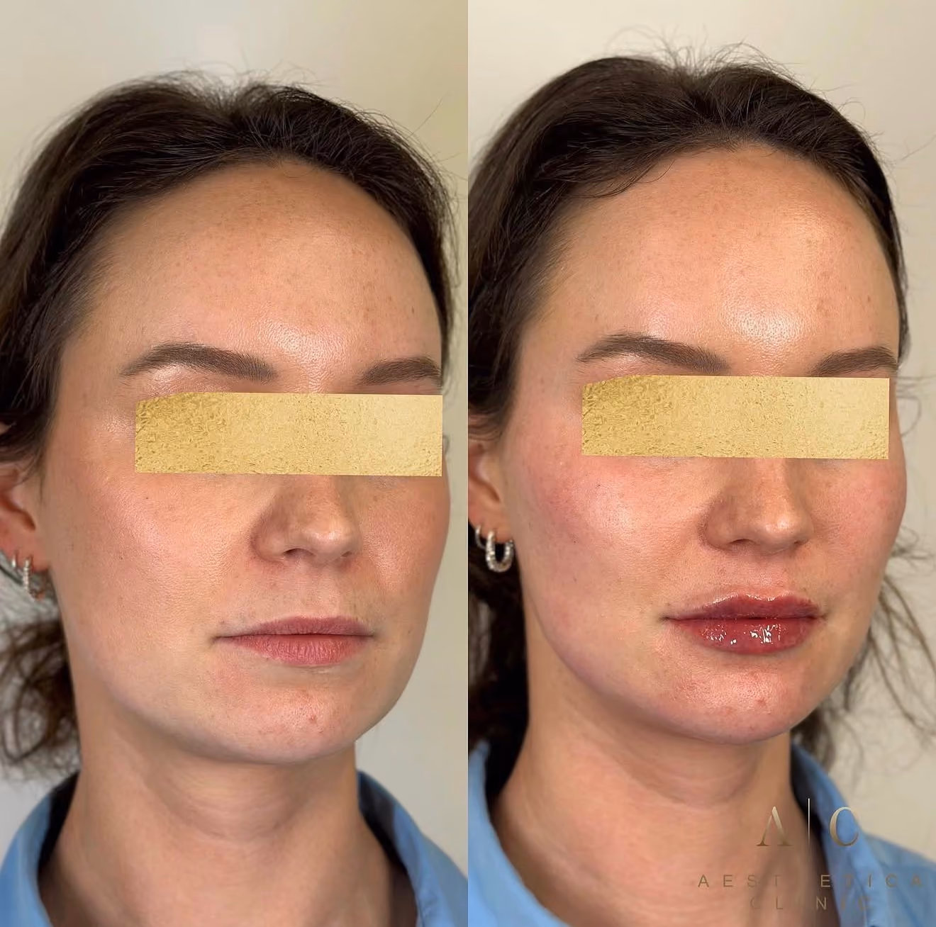 Facial Volume & Contouring Christchurch | Dermal Fillers