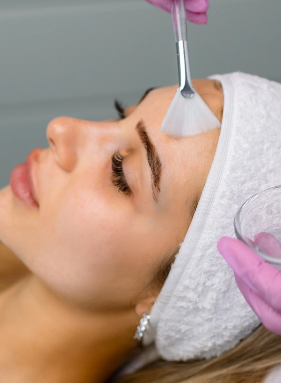 Chemical Peels Naples FL