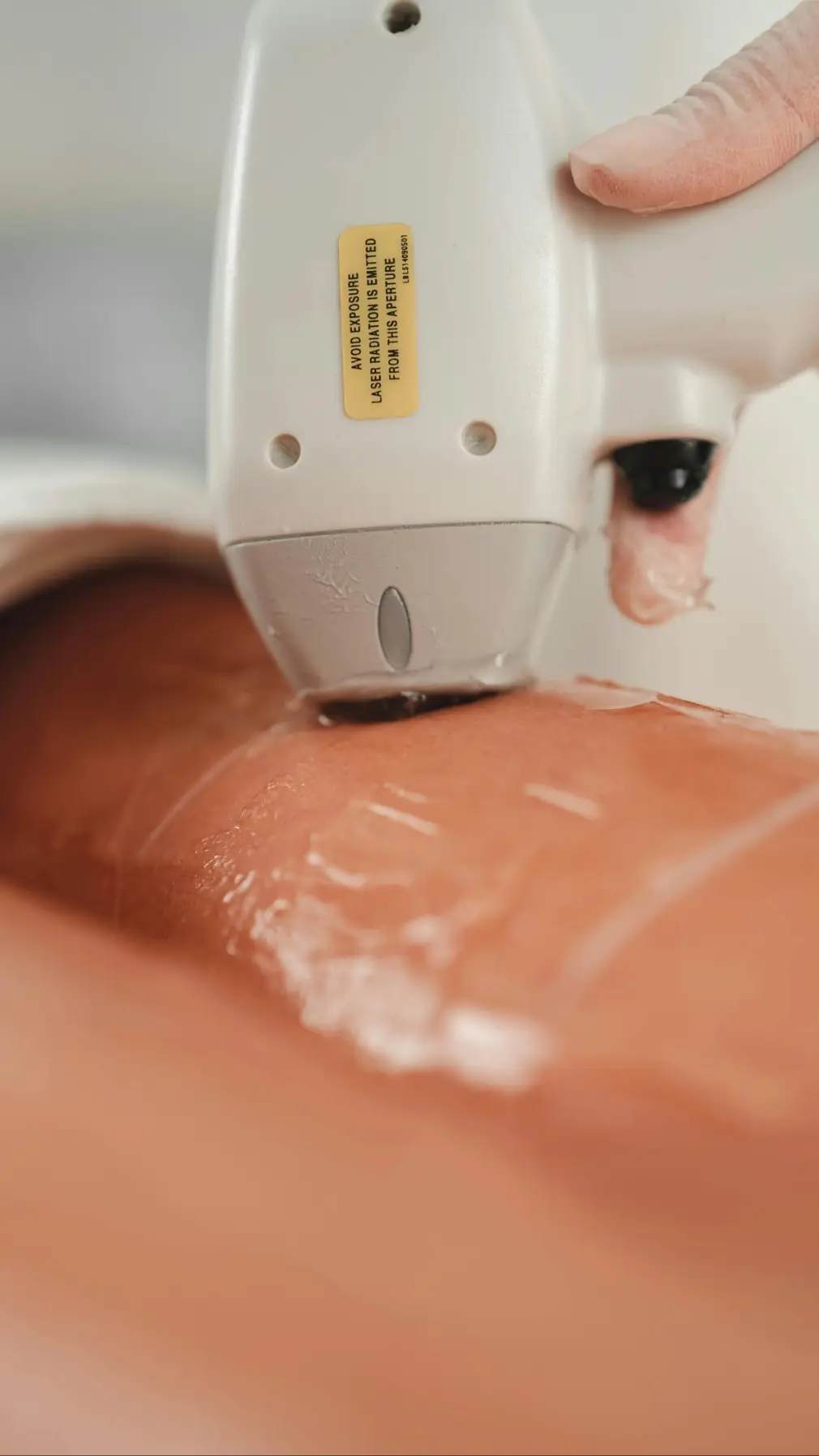 Praticienne réalisant un traitement d'épilation laser sur la jambe d'une cliente avec application de gel.