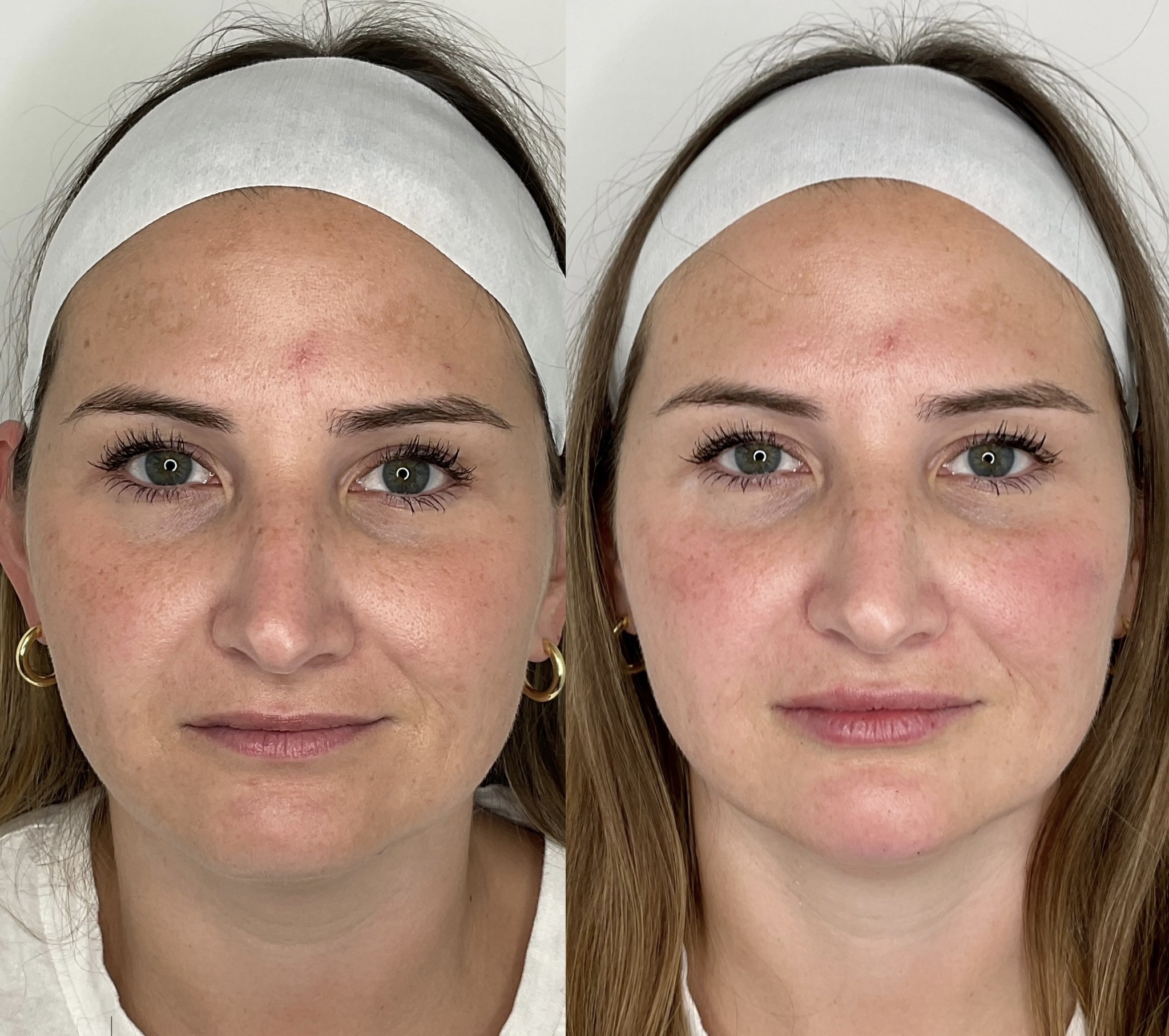 before and after botox to beautify whole face