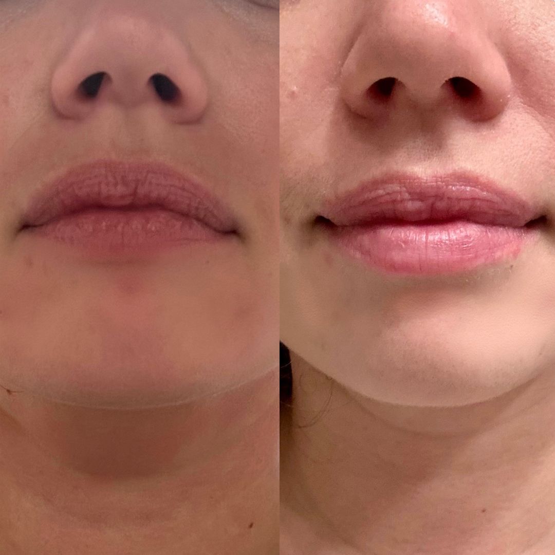 before and after botox to upturn smile