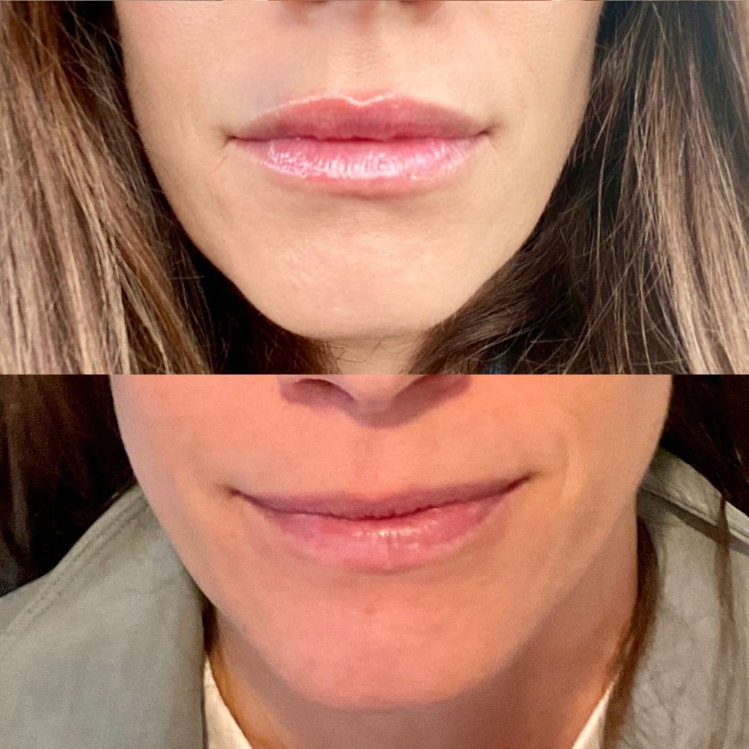 before and after botox to plump lips
