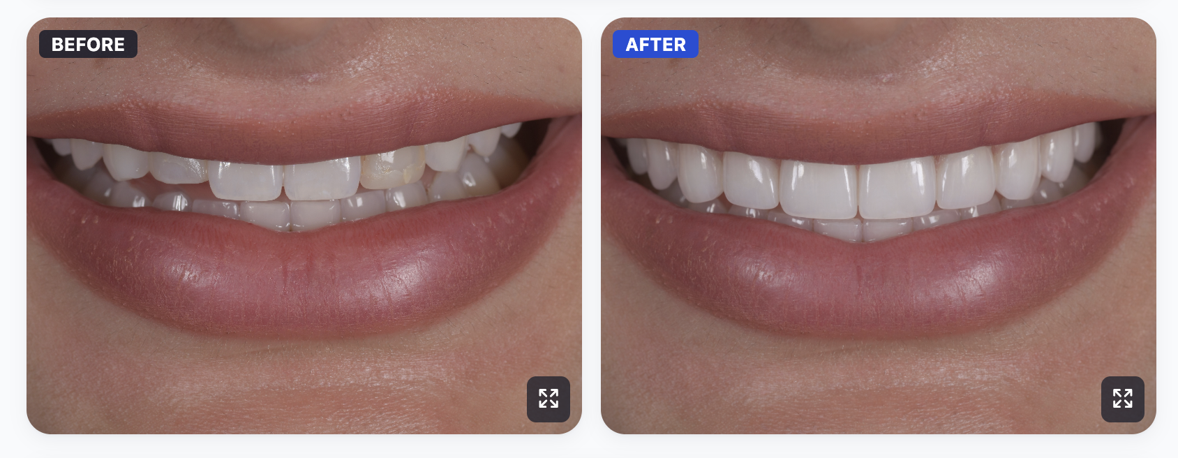 Before and after smile transformation with SmileViz