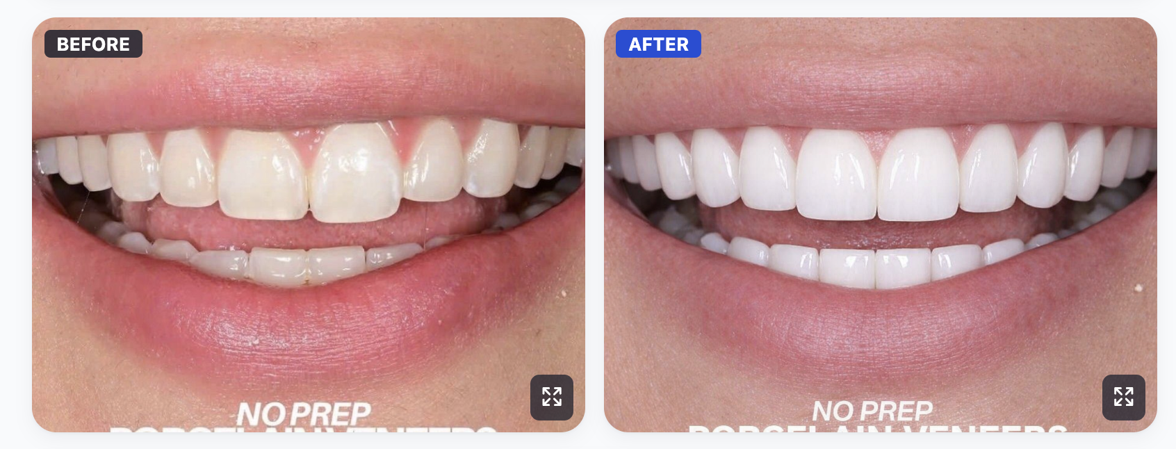 Before and after smile transformation with SmileViz