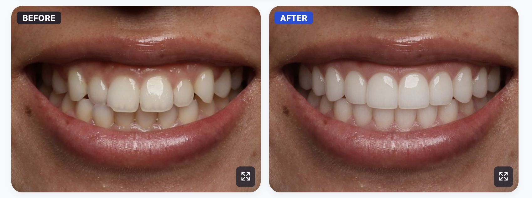 Before and after smile transformation with SmileViz