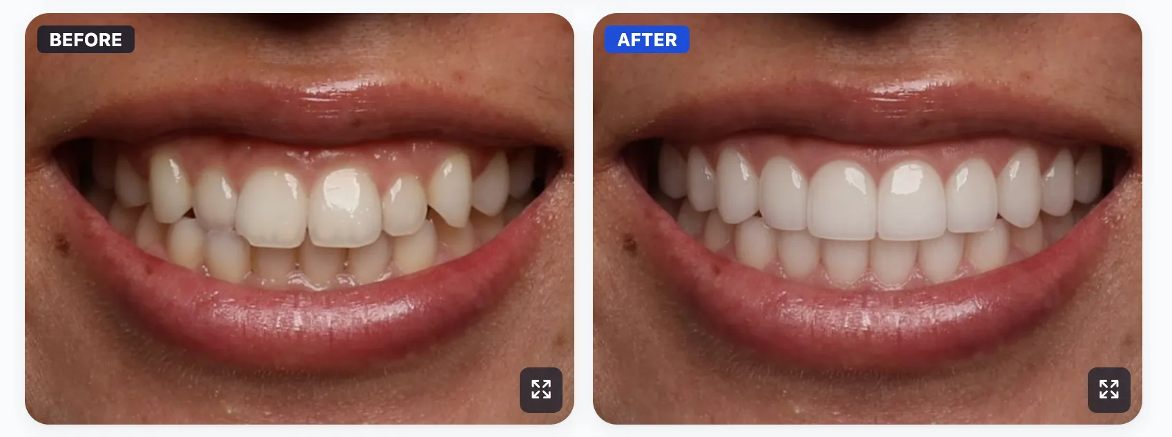 Before and after veneer smile simulation made with SmileViz
