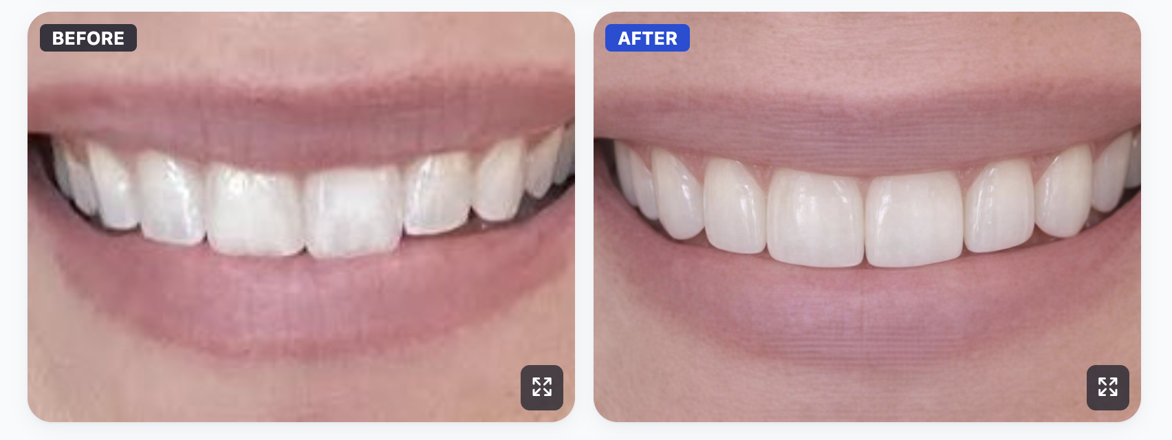 Before and after smile transformation with SmileViz