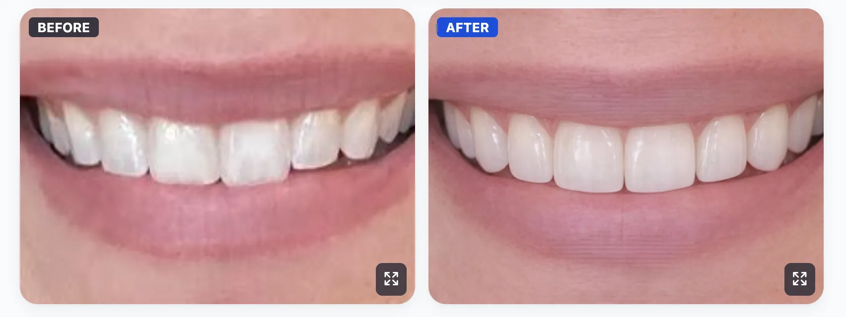 Cosmetic dentistry before and after simulation created with SmileViz