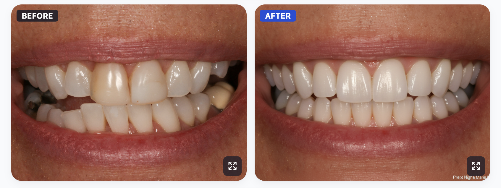 Before and after smile transformation with SmileViz