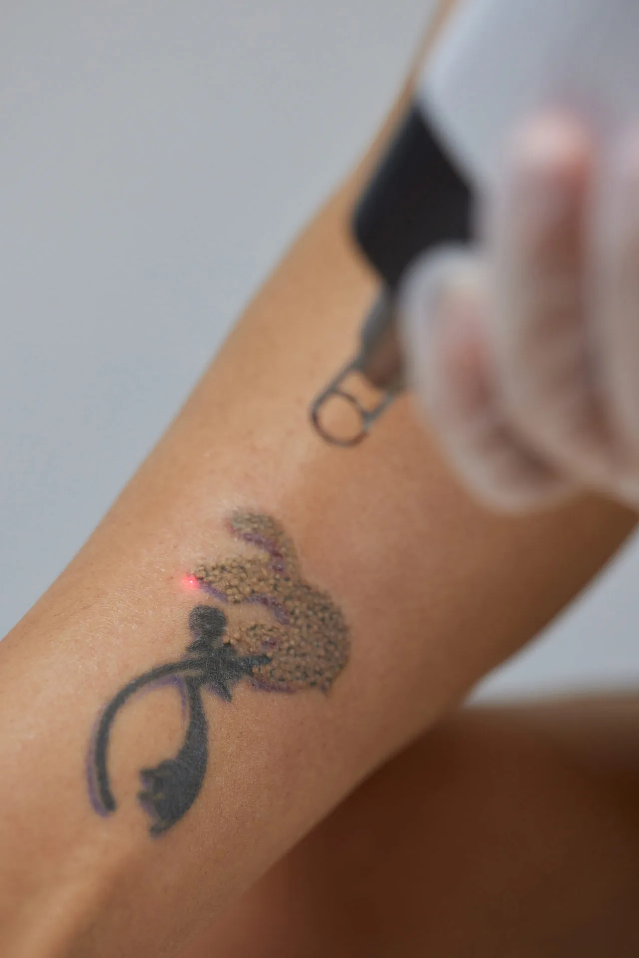Tattoo-Behandlungen