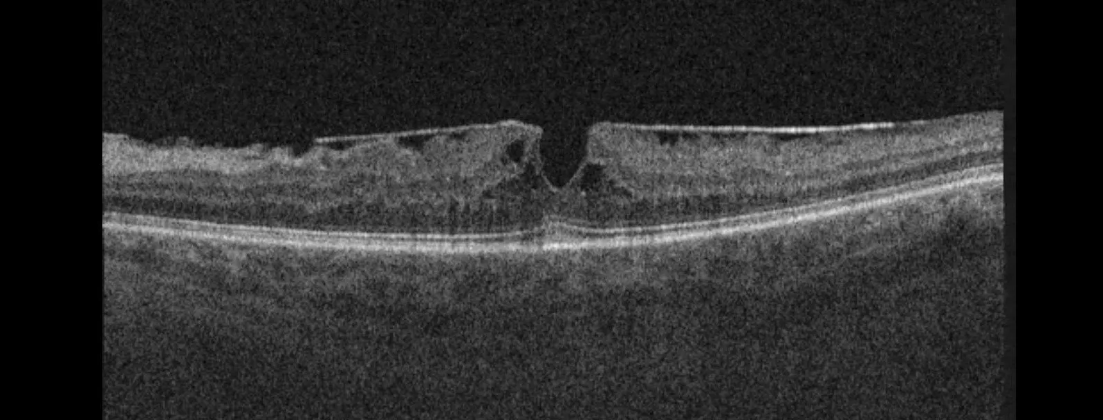 OCT scan of retinal layers showing macula with central depression in cross-section