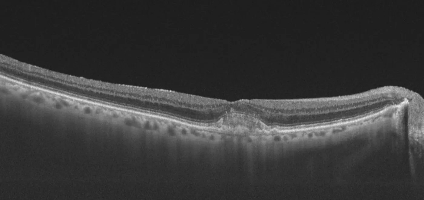 OCT scan of retinal layers showing detailed cross-sectional eye tissue anatomy
