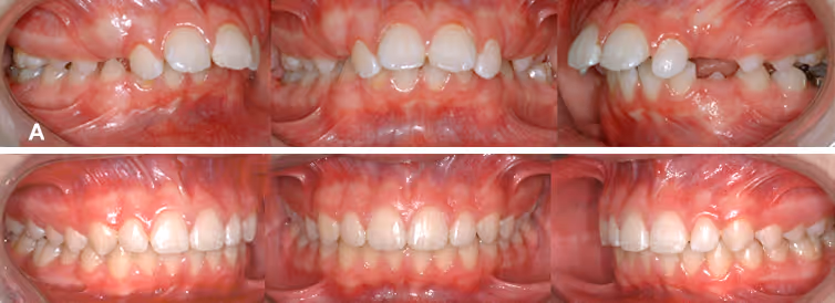 Orthodontie Classe 2 Division 1 Orthodontie 01