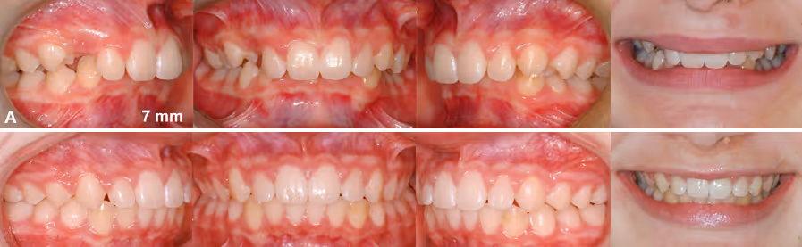 Orthodontie Classe 2 Division 1 Orthodontie 02