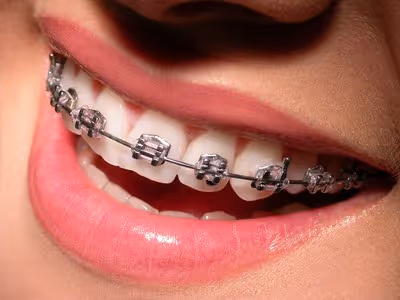 Les différents appareils de rétention orthodontique