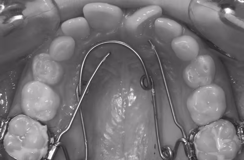 Le QUAD HÉLIX DE A à Z - Partie 4 sur 4