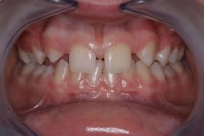 L'agénésie dentaire : quand les dents manquent à l'appel !