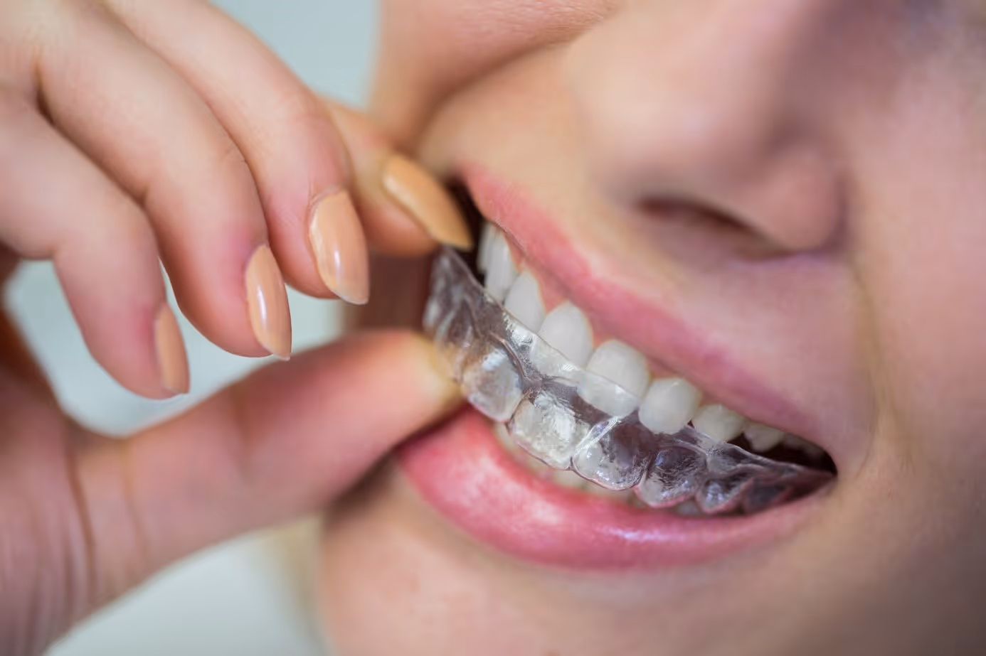 Les Gouttières Invisibles : Une Révolution dans l'Orthodontie