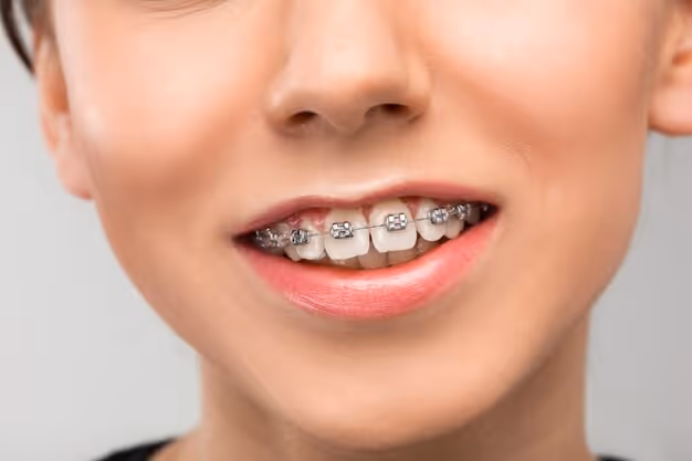 Comprendre et Gérer les Malocclusions de Classe III en Orthodontie