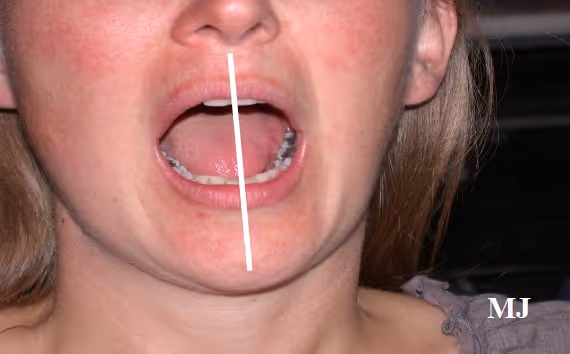 L’ATM et les dysfonctions cranio-mandibulo-cervicales partie 1