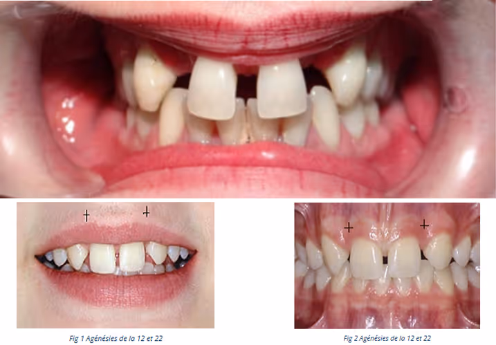 Traitement ODF dans les cas d'agénésies