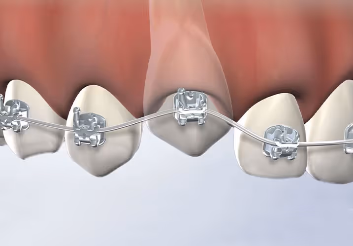 Orthodontie et Dents Incluses : Vers une Gestion Optimisée et Précise