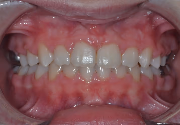 Les Extractions en Orthodontie : Décider en Conscience