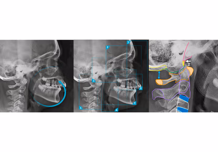 Téléradiographie céphalométrique : un Outil essentiel en orthodontie