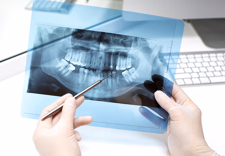 Agénésie dentaire : repères cliniques et stratégies thérapeutiques pour le praticien