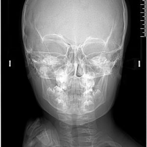 Téléradiographie de face présentée par le Docteur Saïd KHOLOKI