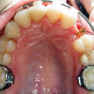 Mise en place orthodontique des dents incluses présentée par le Docteur Firas HAJ IBRAHIM