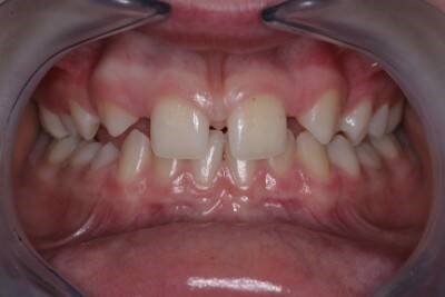 L'agénésie dentaire : quand les dents manquent à l'appel !