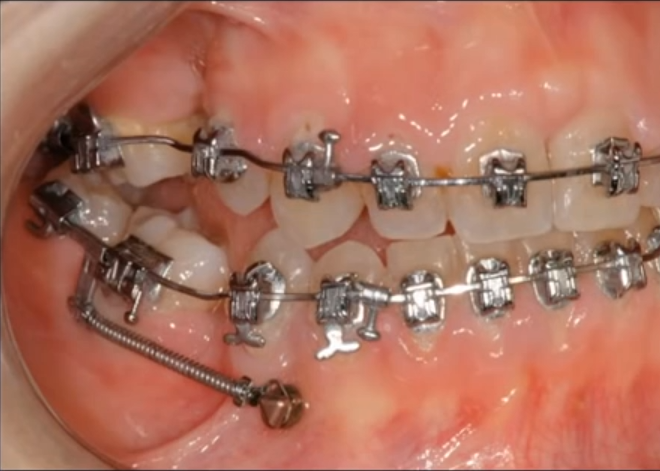L'essor de l'Orthodontie avec les Mini-Vis d'Ancrage L'essor de l'Orthodontie avec les Mini-Vis d'Ancrage