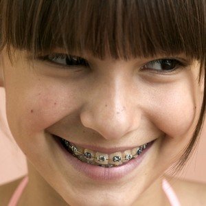 La contention orthodontique La contention orthodontique