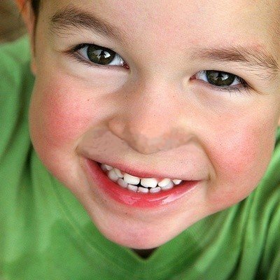Les dents en avant à traiter rapidement en orthodontie Les dents en avant à traiter rapidement en orthodontie