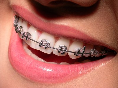 Les différents appareils de rétention orthodontique