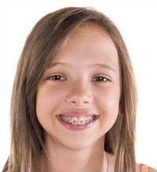 L’enfance, les dents et l’ orthodontie précoce