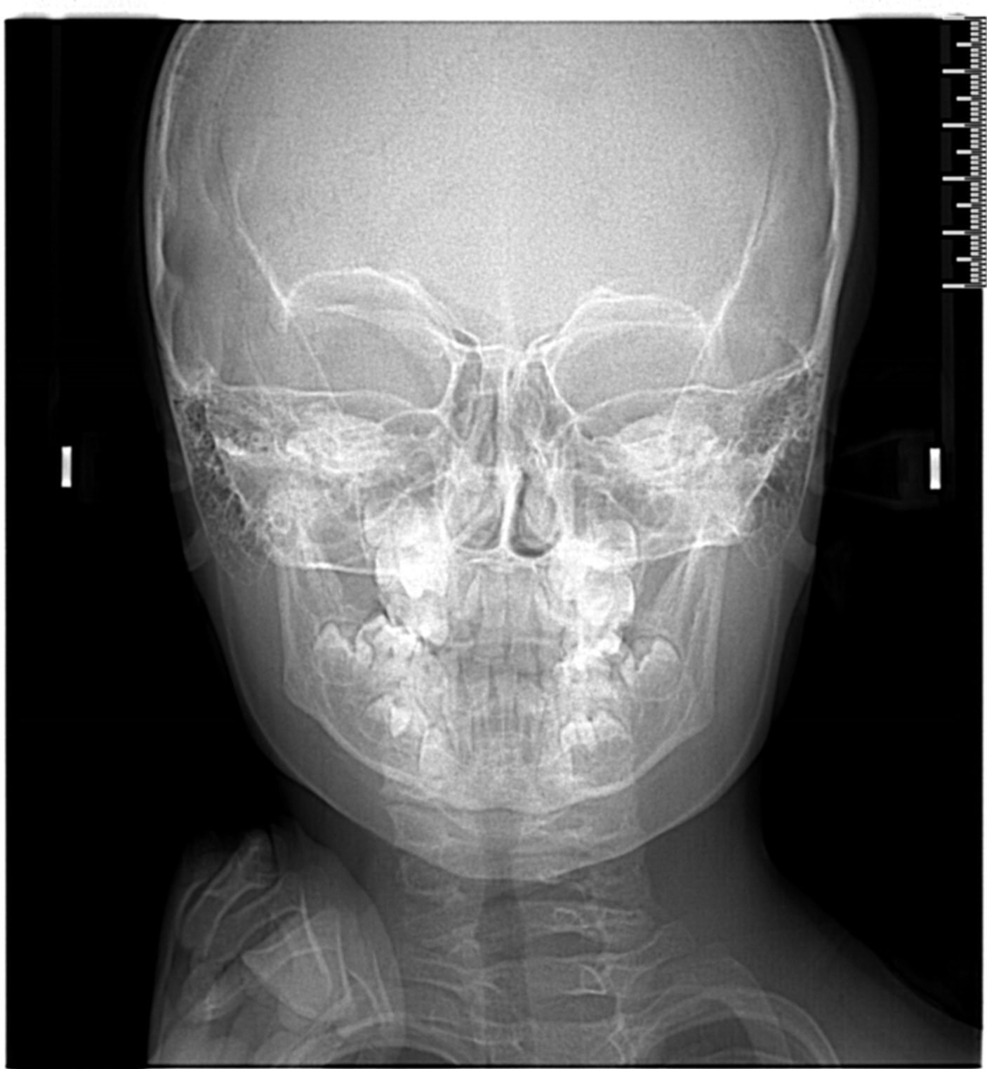 Radiologie céphalo ou téléradiographie Radiologie céphalo ou téléradiographie