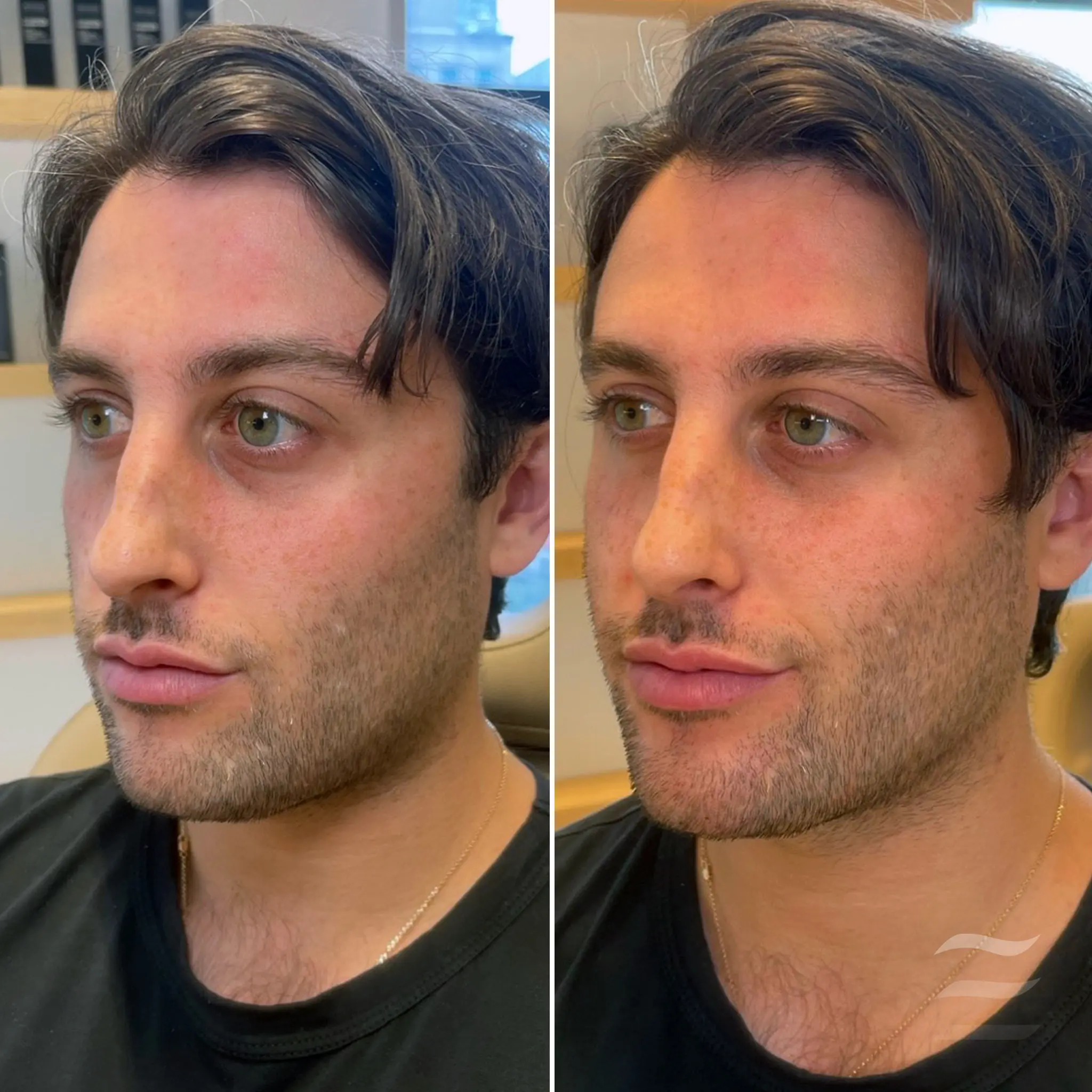 Cheek and Chin Filler