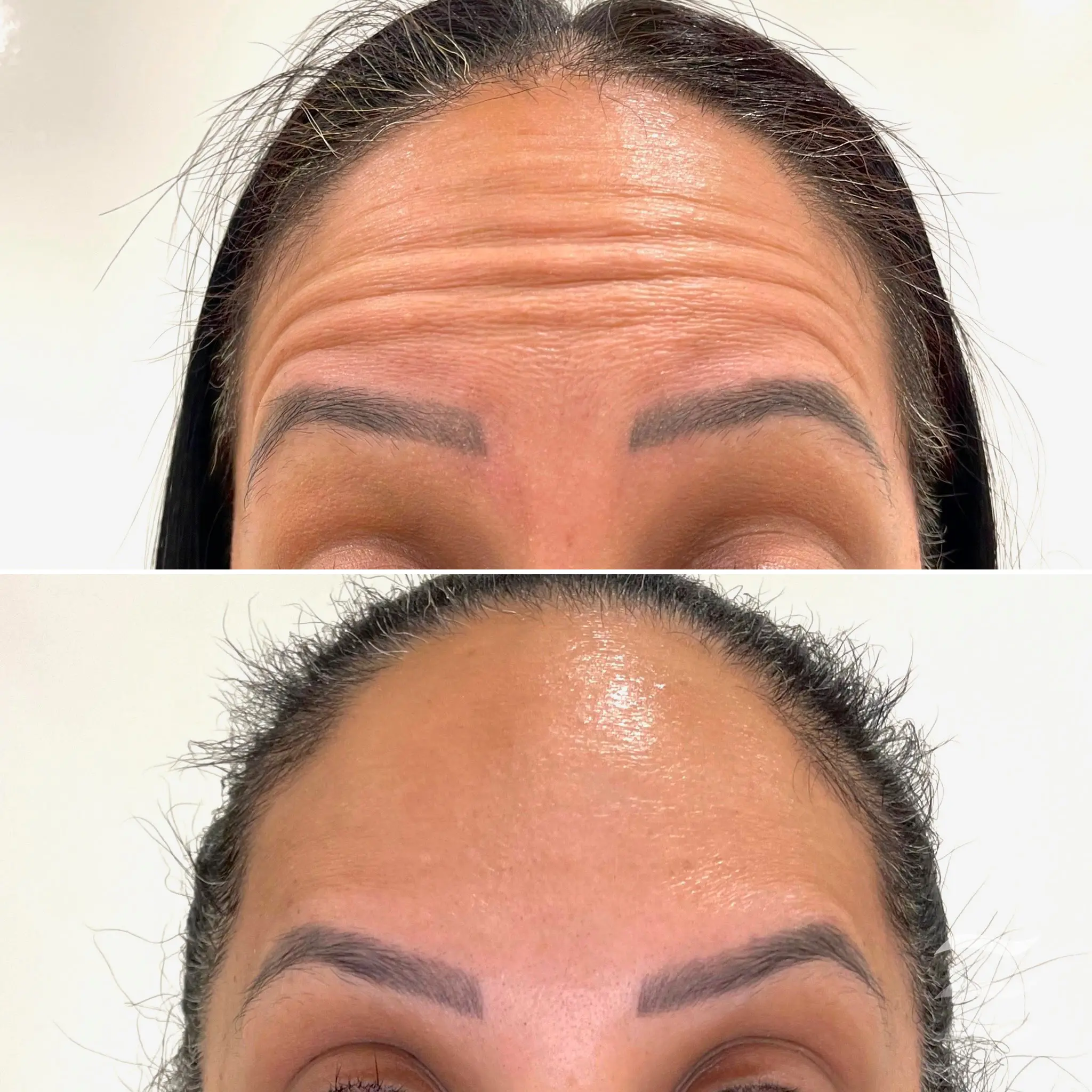 Forehead Lines Botox