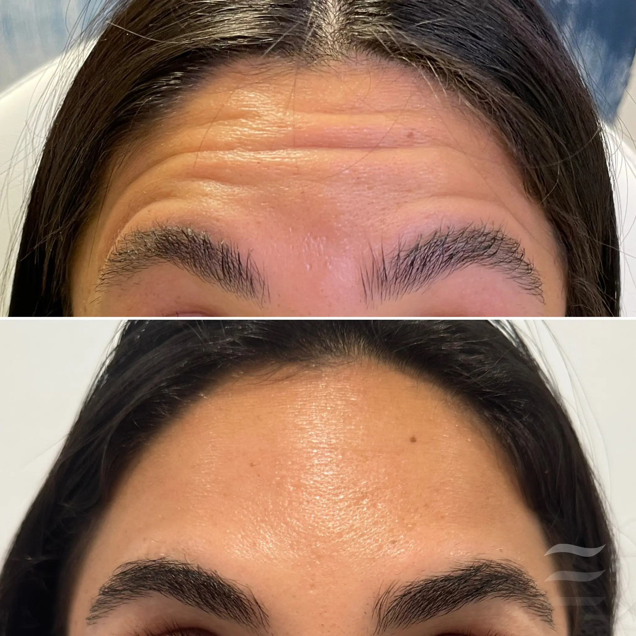 Forehead Lines Botox