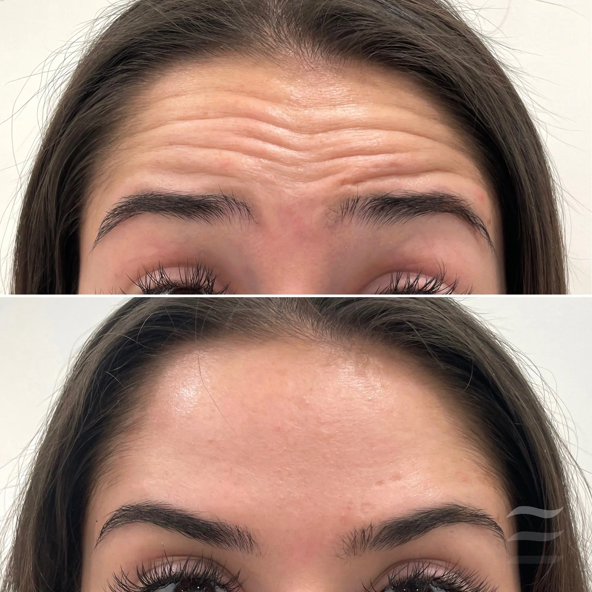 Forehead Lines Botox