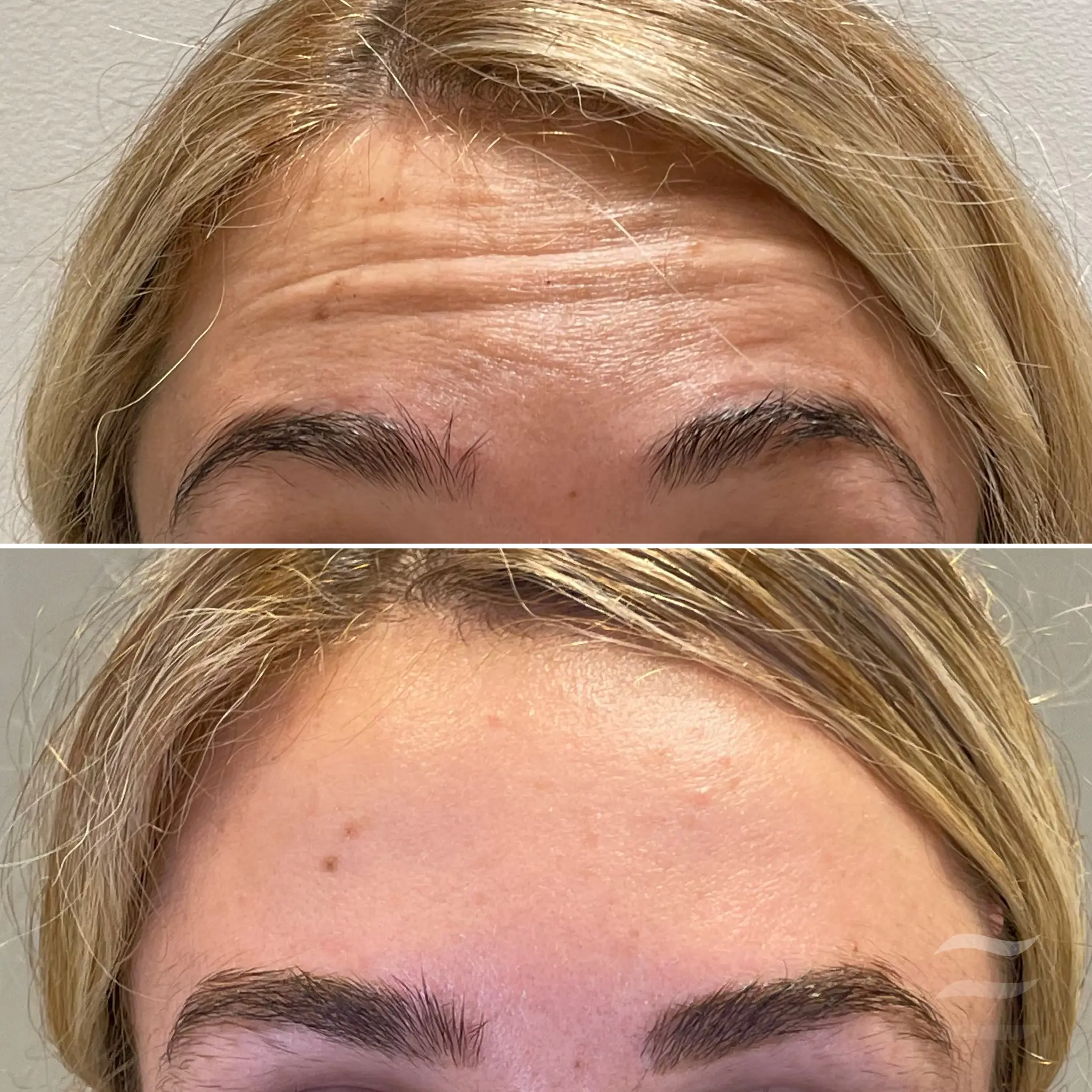 Forehead Lines Botox