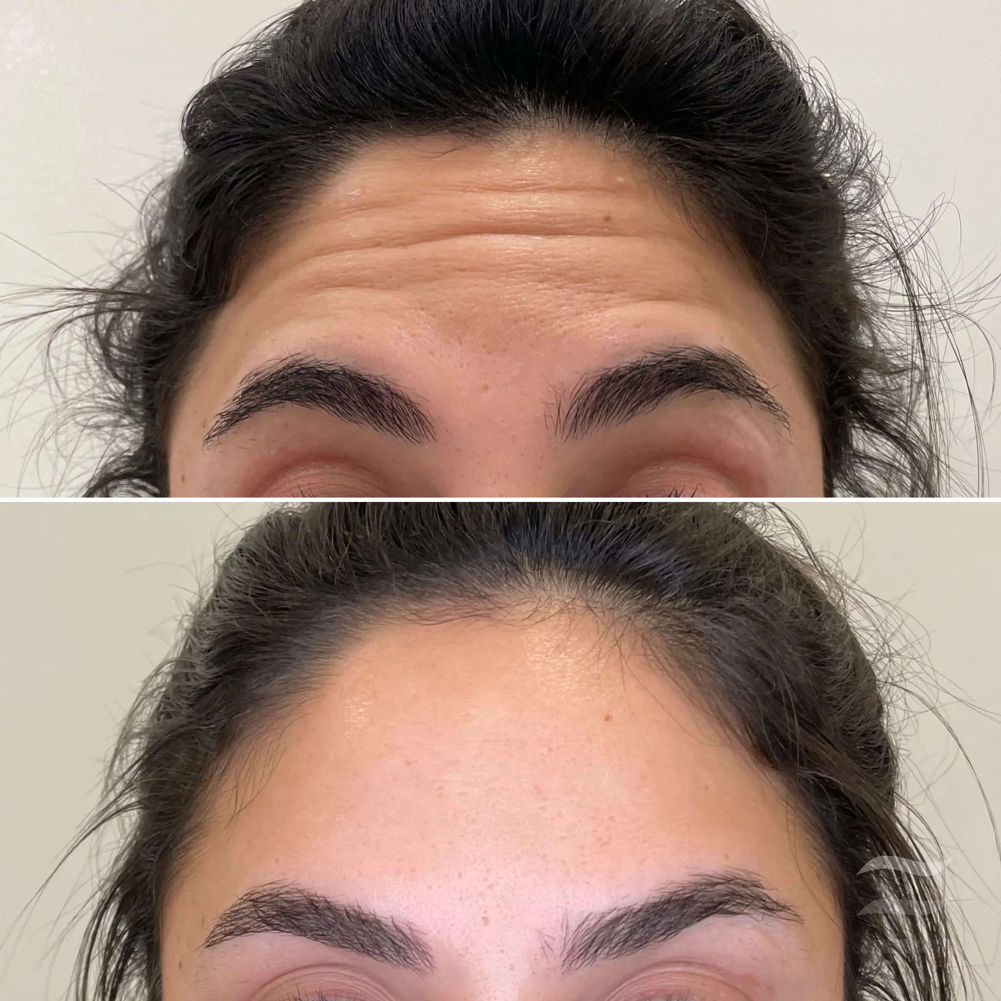 Forehead Lines Botox