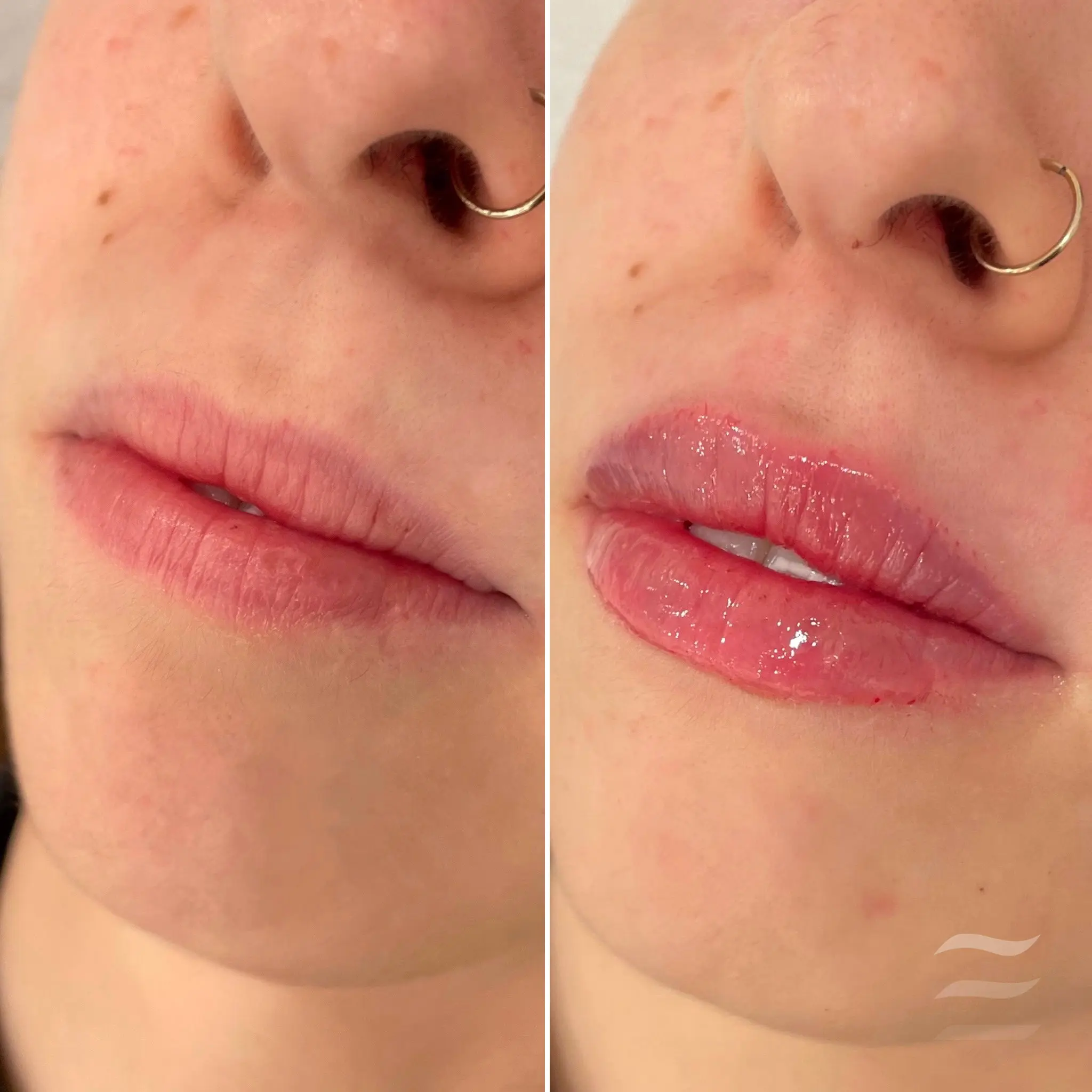 Lip Filler