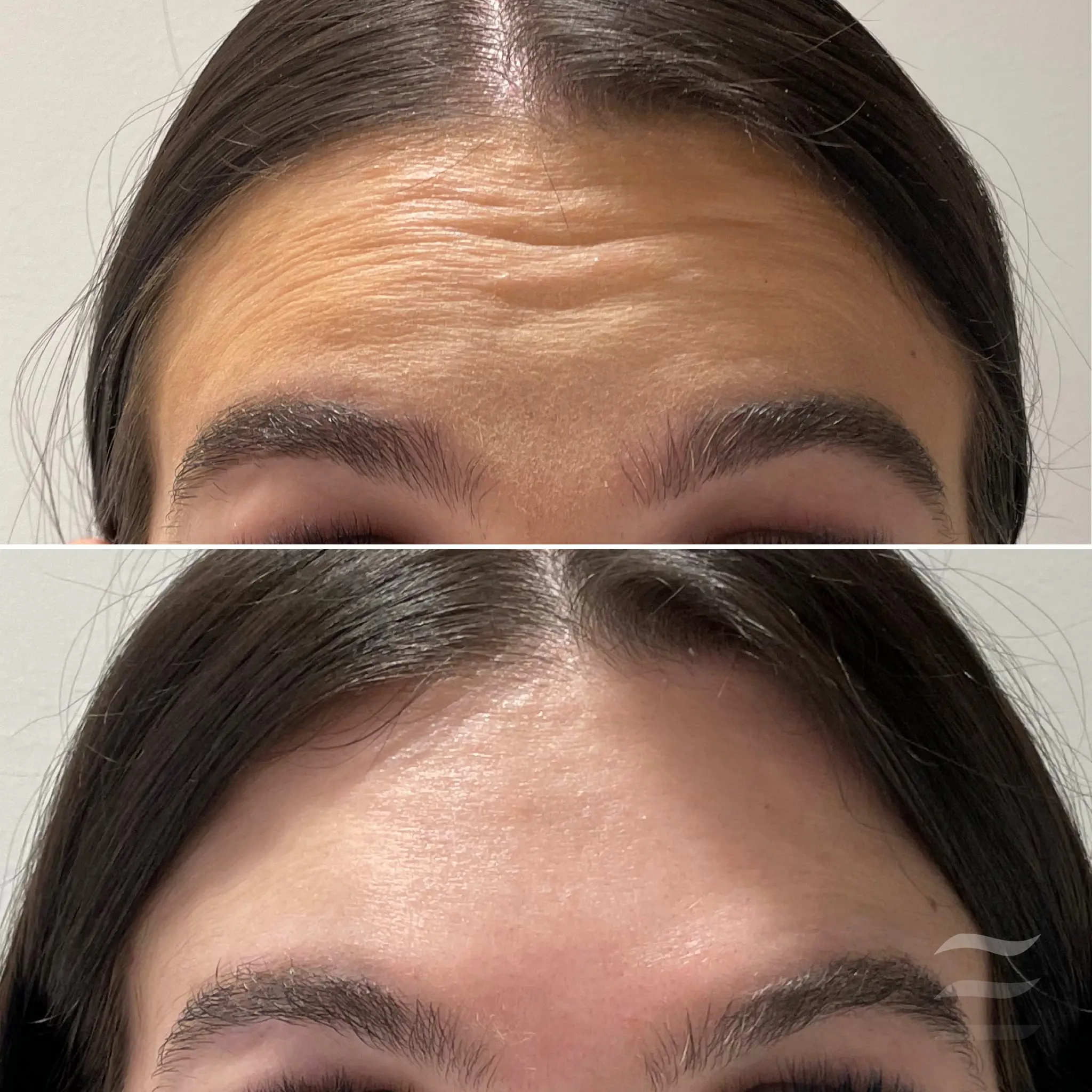Forehead Lines Botox